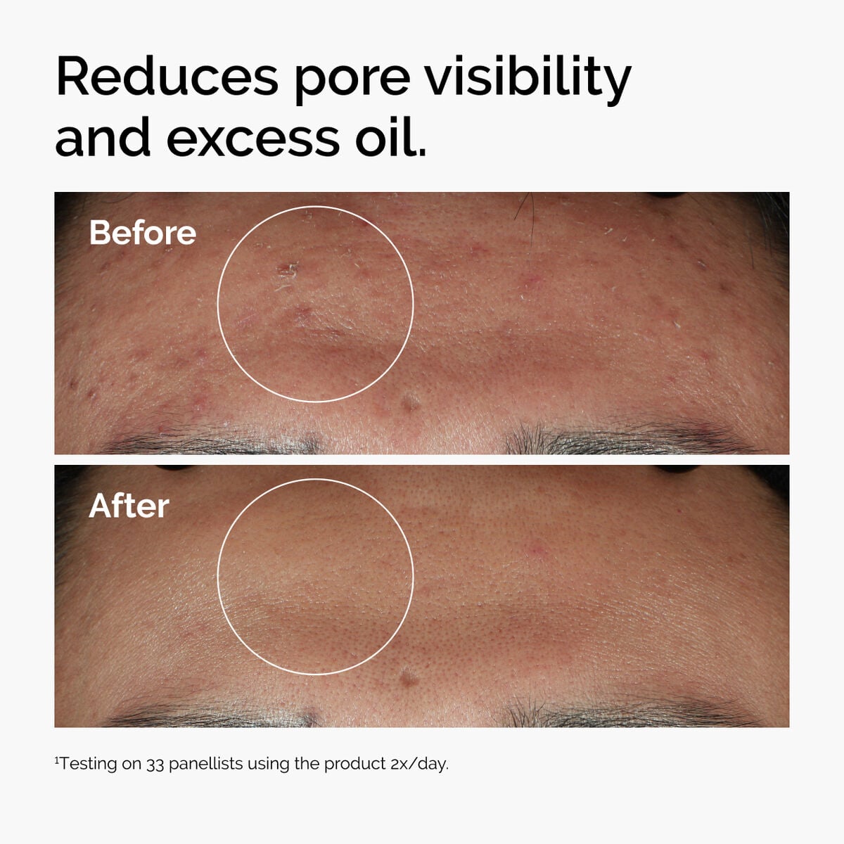 niacinamide-10-zinc-1-t3 ord-niacinamide-zinc-blemish-serum-before-after-pores.jpg