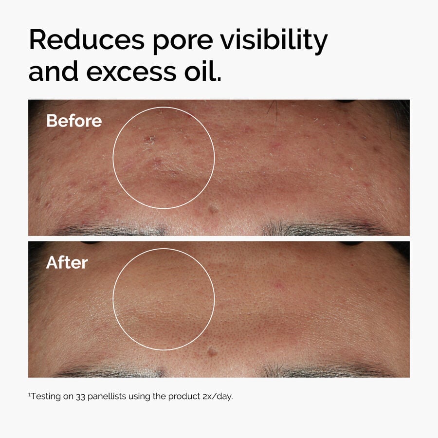 niacinamide-10-zinc-1-t3 ord-niacinamide-zinc-blemish-serum-before-after-pores.jpg