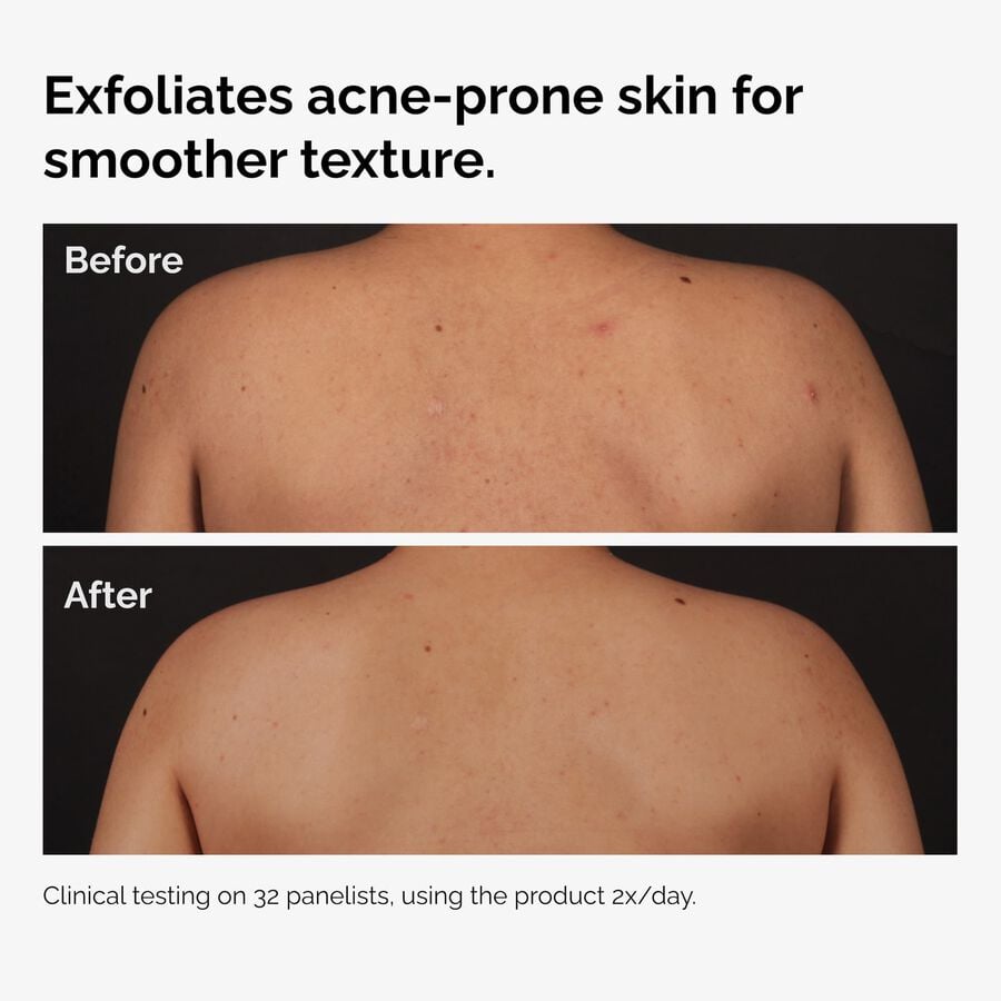the-body-care-collection-d2 ord-salicylic-acid-body-serum-before-after-graphic-NA.jpg